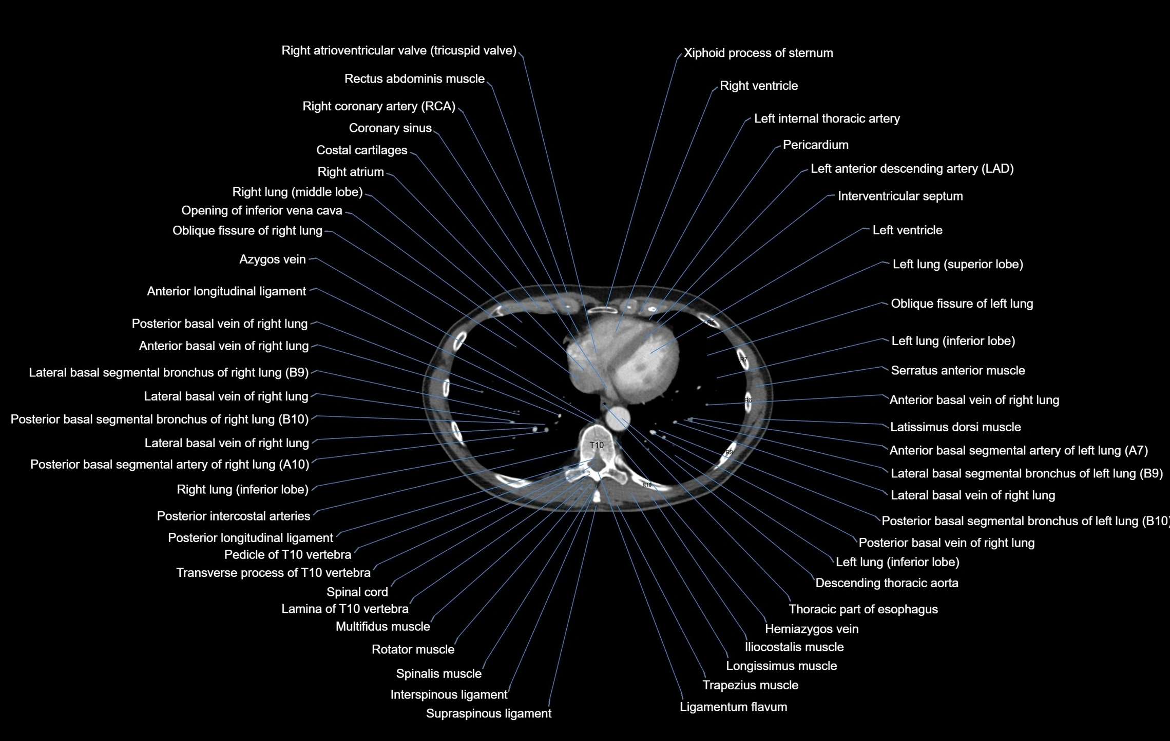 CT chest (thorax) soft tissue window labelled axial cross sectional anatomy radiology image-00088.webp